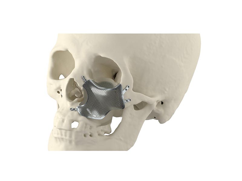 Mid-Face Reconstruction