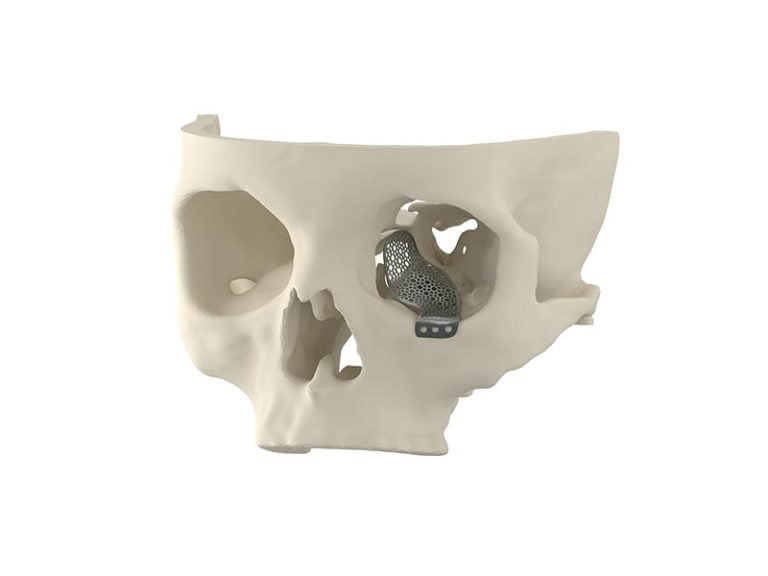 Oculoplastic Reconstruction