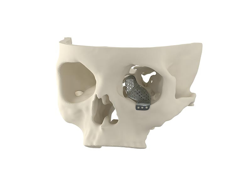 Oculoplastic Reconstruction