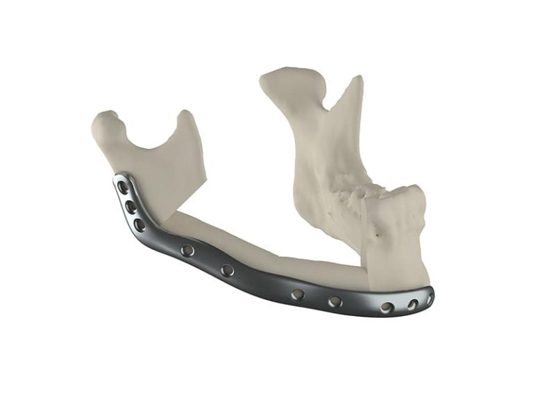 Mandible Reconstruction
